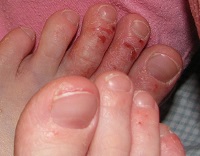 Алергічний дерматит на ногах у дорослих: фото, лікування
